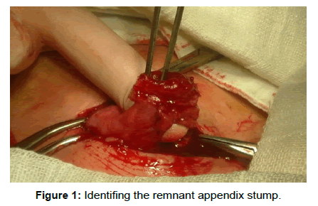 surgery-clinical-practice-remnant-appendix-stump