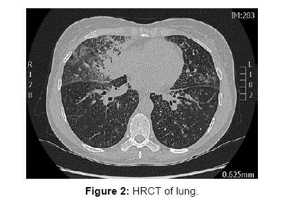 transplantation-studies-HRCT-lung