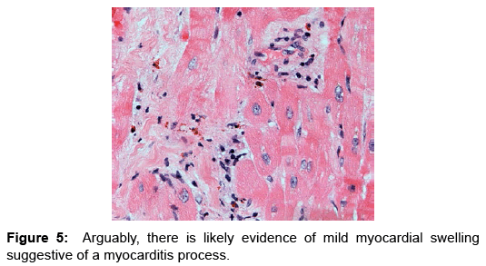 transplantation-studies-myocarditis-process