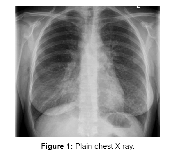 transplantation-studies-plain-chest-X-ray