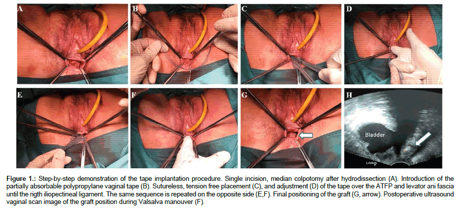 womens-health-issues-Single-incision