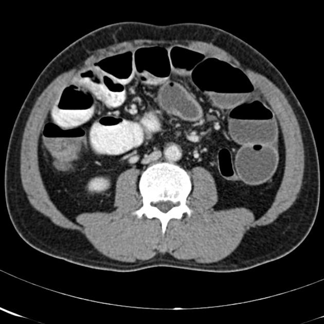 Caecal Metastasis: An Exceptional Manifestation Mode Revealing Small Cell Lung Carcinoma: Clinical Case and Review of the Literature