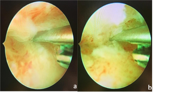 Treatment of Thin Endometrium with Hysteroscopic Autologous Platelet Rich Plasma Injection