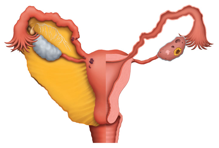 Current Challenges in the Diagnosis of Deep Infiltrating Endometriosis