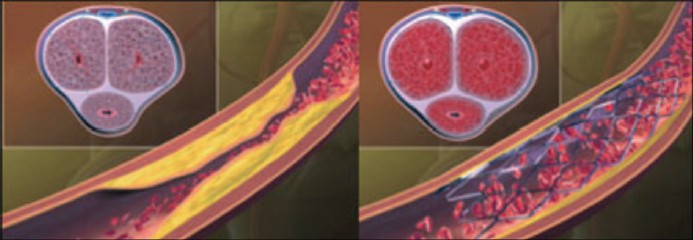 Shock Wave Therapy inVasculogenic Erectile Dysfunction