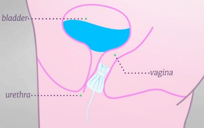 MiniArc Sling for the Treatment of Female Stress Urinary Incontinence