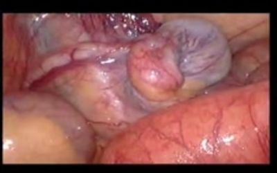 Testicular Microlithiasis among Infertile Men: A Reason for Concern?
