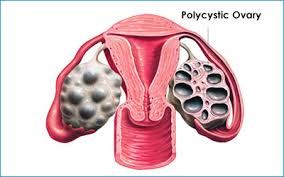 Aromatase Inhibitor for Prevention of Ovarian Hyperstimulation Syndrome(OHSS)