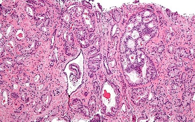 Discovery of a New Anti Androgen Compound