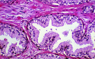 Prostatic Tissue Level of some Androgen Dependent and Independent Trace Elements in Patients with Benign Prostatic Hyperplasia