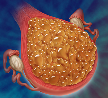 Gestational Trophoblastic Neoplasia Series of 17 Cases