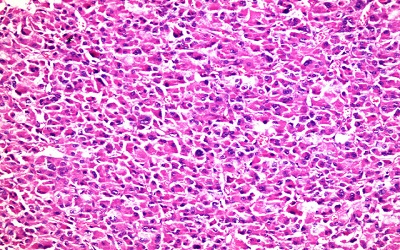 Hormonally Active Adrenocortical Oncocytic Carcinoma Presenting with Hirsutism and Amenorrhea: A Rare Case Report and Literature Review
