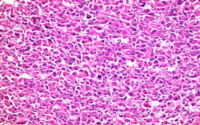 Hormonally Active Adrenocortical Oncocytic Carcinoma Presenting with Hirsutism and Amenorrhea: A Rare Case Report and Literature Review