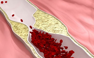 Atherosclerosis and the Menopause