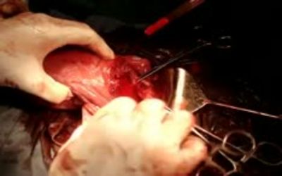 Finding Fibers: Intrauterine Synechia of the Lower Uterus after Cesarean Section