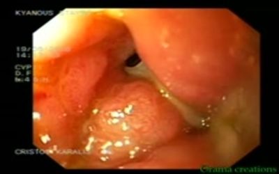 Spontaneous Resolution of 
an Iatrogenic Ureterovaginal 
Fistula after Clinical Treatment of Hypothyroidism: A Case Study with a Review of the Literature