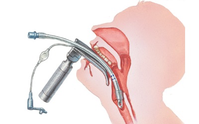 Repeat Percutaneous Tracheostomy is Safe- A Retrospective Analysis of 15 Cases
