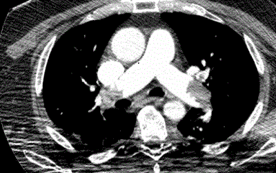 Fulminant Pulmonary Embolism Successfully Treated with Thrombolysis