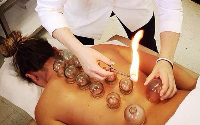 Cupping Therapy: Well Forgotten Therapy