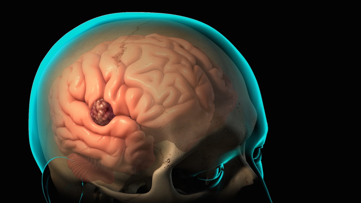 Decompressive Craniectomy in a Patient with Severe Traumatic Brain Injury during Mild Therapeutic Hypothermia