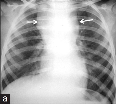 Paediatric Anterior Mediastinal Mass: A Night Mare for the Anaesthesiologist & the Need for a Systematic Evidence Based Approach towards Management of Anterior Mediastinal Mass in Paediatric Population