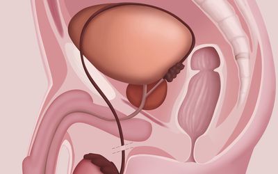 One, Two, Three, Four, Five and Six: The Parturient with Six Urinary Catheters during the Peripartum Period