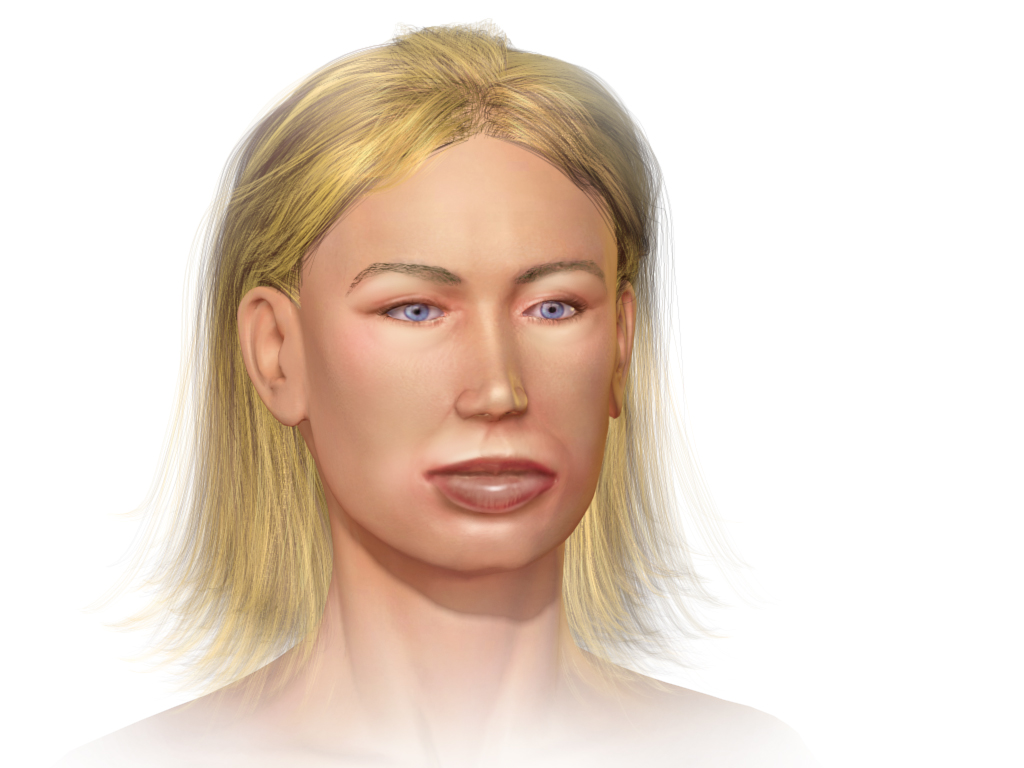 Angioedema of the Tongue: An Exceptional Side Effect of Artemether