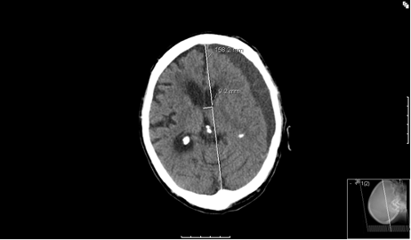A Rare Complication of Severe Pre-Eclampsia: Acute Spontaneous Subdural Haematoma