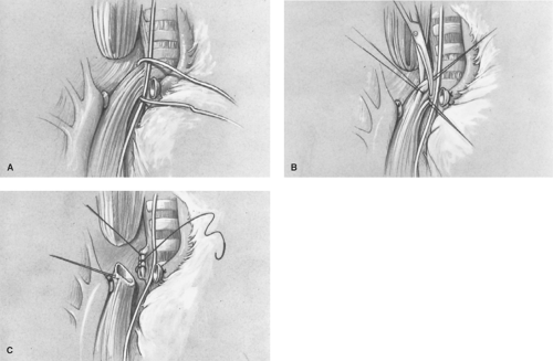 An Emergency Case: A Successful Anesthetic Management of Aorta-Trachea Fistula