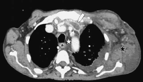 Descending Necrotizing Mediastinitis of Odontogenic Origin: About a Case at the University Hospital Center of Bouake