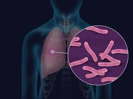 Tuberculosis Outcome in Solid Organ Transplant Recipients