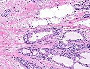 Chronic Antibody Mediated Rejection, a Continuous and Complex Lesion