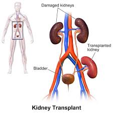 Practice Patterns in the Acceptance of Medically Complex Living Kidney Donors with Obesity, Hypertension, Family History of Kidney Disease, or Donor-Recipient Age Discrepancy