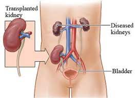 Multiple Renal Arteries in Live Donor Renal Transplantation