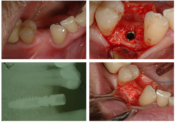 Clinical Performance of Moldable Bioceramics and Resorbable Membrane for Bone and Mucosa Regeneration in Maxillofacial Surgery