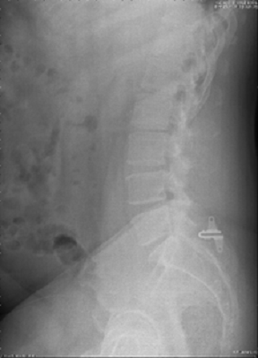 Different Interspinous Stabilization Systems: Market Evaluation