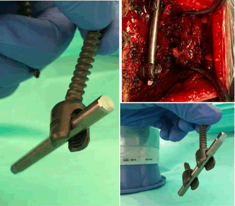 A New Titanium System to Help Spinal Surgeon