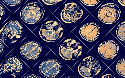 Potential stem cell therapy for Alzheimer’s disease and Parkinson’s disease