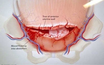 Application of clinical grade hUC-MSCs in the treatment of uterine scars in rats