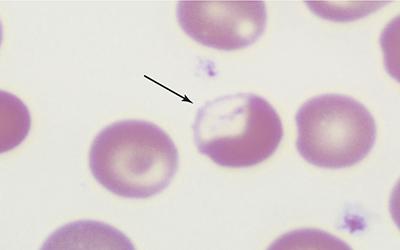 Ck AE1/AE3 Tumor Marker Expression in SCC of Head and Neck