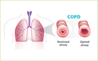 Chronic Obstructive Lung Disease, Stem Cells and Telocytes: Review of Therapeutic