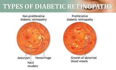 Treatment Options for the Patients with Diabetic Retinopathy