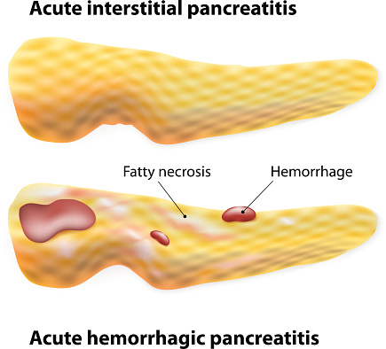 Inflammation and Pancreatic Cancer: A Tale of Two Cytokines