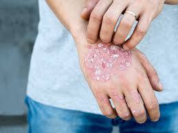 Epidemiology of Psoriasis: Comorbidities Frequency and Healthcare Services: A Descriptive Study of 122 189 Patients in Mexico