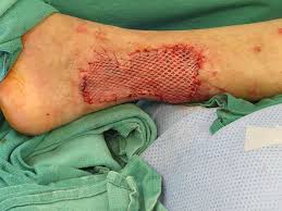 Short Communication on Skin Graft