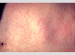 Toxic epidermal necrolysis associated with acute measles infection