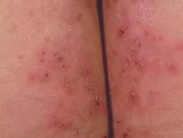 Dermatitis Herpetiformis: A Gluten-Related Disorder