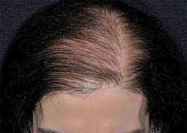 Hypertension and Cicatricial Hair Loss in Women