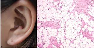Lipoma on Antitragus of the Ear