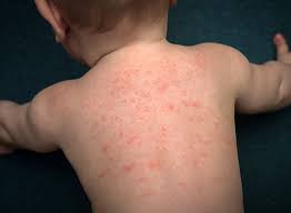 Rash in an Infant Born with Low Weight